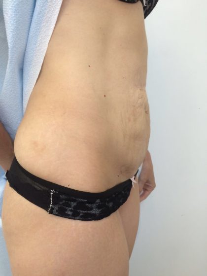 Tummy Tuck Before & After Patient #5596