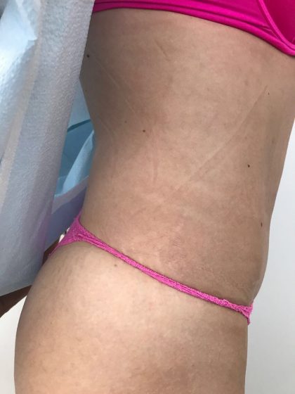 Tummy Tuck Before & After Patient #5596