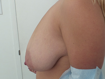 Breast Reduction Before & After Patient #5725
