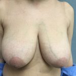 Breast Reduction Before & After Patient #5720