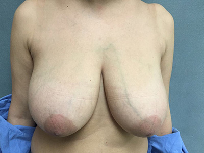 Breast Reduction Before & After Patient #5720