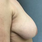 Breast Reduction Before & After Patient #5720