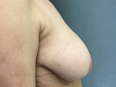 Breast Reduction Before & After Patient #5720