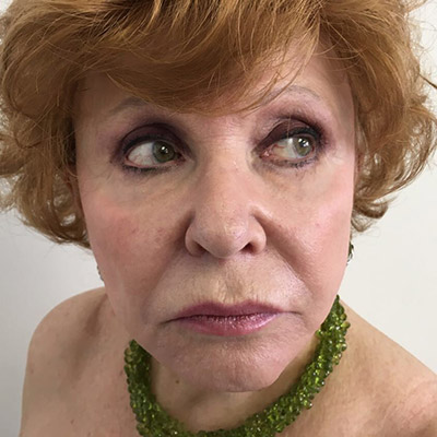 Facelift Before & After Patient #5732