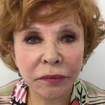 Facelift Before & After Patient #5732