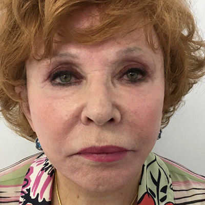 Facelift Before & After Patient #5732