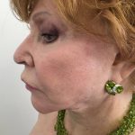 Facelift Before & After Patient #5732