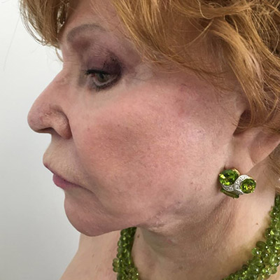 Facelift Before & After Patient #5732