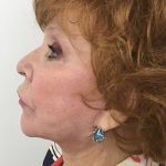 Facelift Before & After Patient #5732