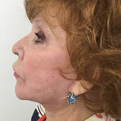 Facelift Before & After Patient #5732