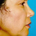 Instalift Before & After Patient #5880