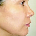 Instalift Before & After Patient #5880