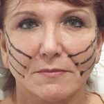 Instalift Before & After Patient #5877