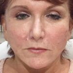 Instalift Before & After Patient #5877