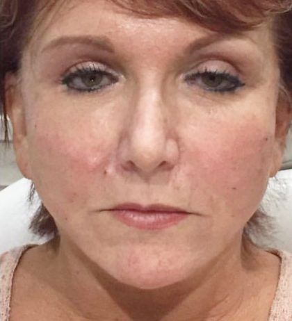 Instalift Before & After Patient #5877