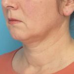 Instalift Before & After Patient #5871