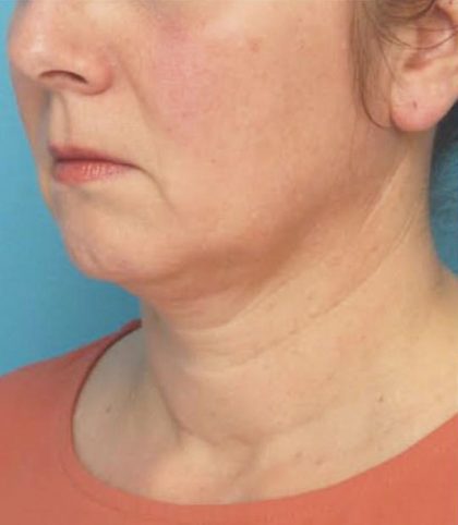 Instalift Before & After Patient #5871