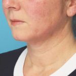 Instalift Before & After Patient #5871