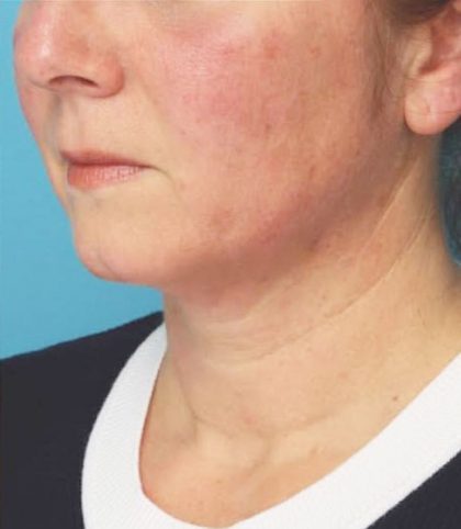 Instalift Before & After Patient #5871