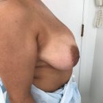 Breast Reduction Before & After Patient #5953