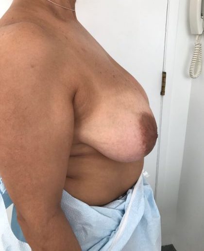 Breast Reduction Before & After Patient #5953