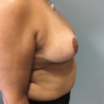 Breast Reduction Before & After Patient #5953