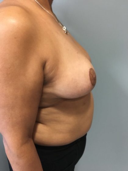Breast Reduction Before & After Patient #5953