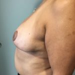 Breast Reduction Before & After Patient #5953