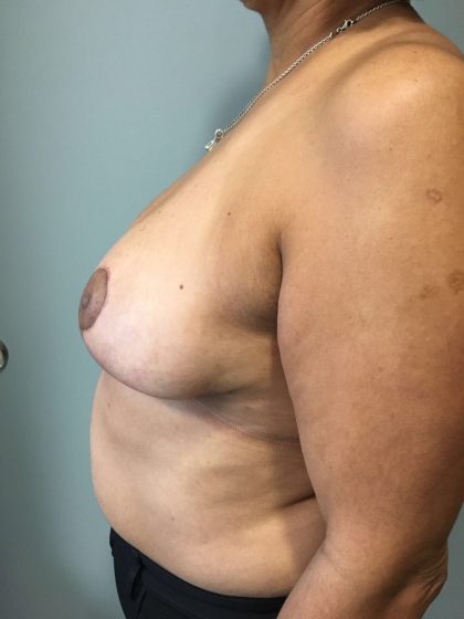 Breast Reduction Before & After Patient #5953