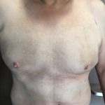 Gynecomastia Before & After Patient #5962