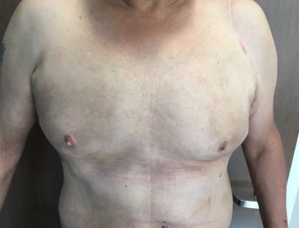 Gynecomastia Before & After Patient #5962