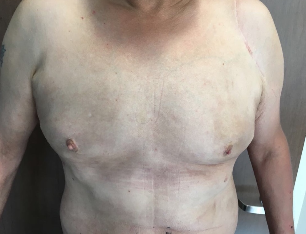 Gynecomastia Before & After Patient #5962