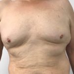 Gynecomastia Before & After Patient #5962