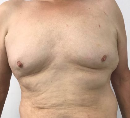 Gynecomastia Before & After Patient #5962