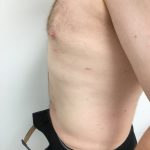 Liposuction Before & After Patient #5981