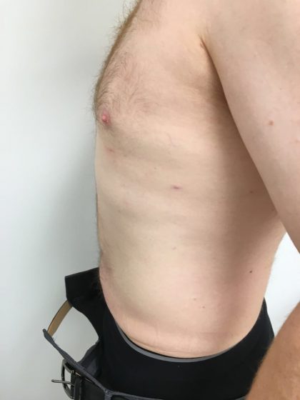 Liposuction Before & After Patient #5981
