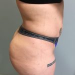 Brazilian Butt Lift Before & After Patient #6001