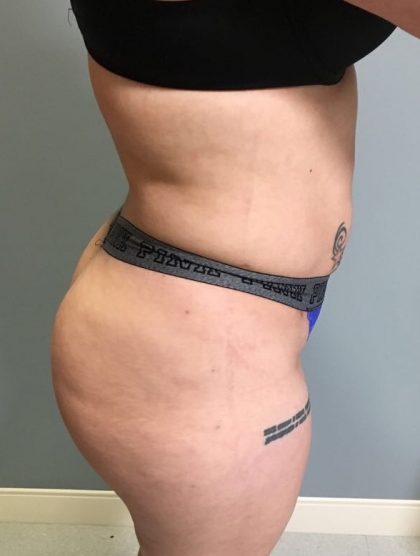 Brazilian Butt Lift Before & After Patient #6001
