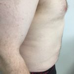Liposuction Before & After Patient #5981
