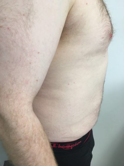 Liposuction Before & After Patient #5981
