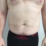 Liposuction Before & After Patient #5981