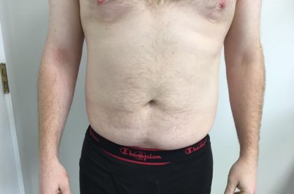 Liposuction Before & After Patient #5981