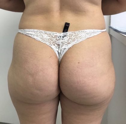 Brazilian Butt Lift Before & After Patient #6001