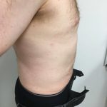 Liposuction Before & After Patient #5981