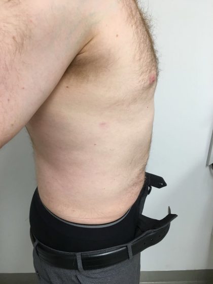 Liposuction Before & After Patient #5981