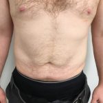 Liposuction Before & After Patient #5981
