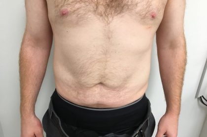 Liposuction Before & After Patient #5981