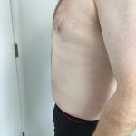 Liposuction Before & After Patient #5981