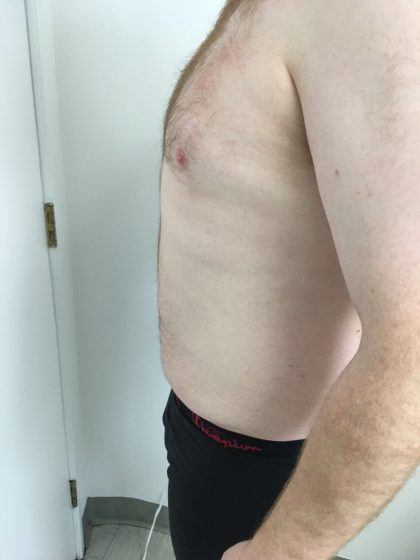 Liposuction Before & After Patient #5981