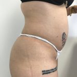 Brazilian Butt Lift Before & After Patient #6001